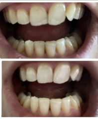 The dental polisher thing - I can't find the thread.