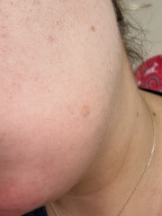 Pregnancy skin