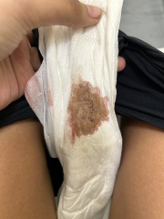 Is this implantation bleeding or my period?