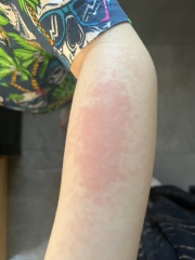 About this rash on my son