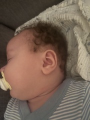 Baby has one ear bigger than other