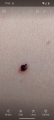Could this be melanoma?