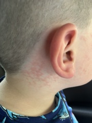 About this rash on my son