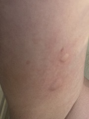 Weird lump suddenly appeared on arm by implant
