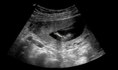 Gender scan told boy