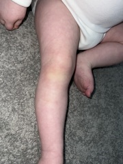 Bruises on 15 month old - are they normal?