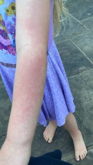What could this rash be??pictures