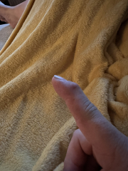 Osteoarthritis in finger joints