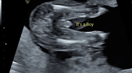 Gender scan - definitely a boy?