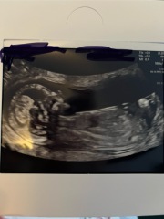 Nub theory 12 and 20 weeks