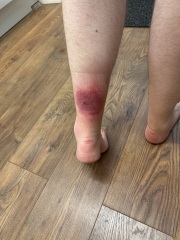 Infection after bug bite?