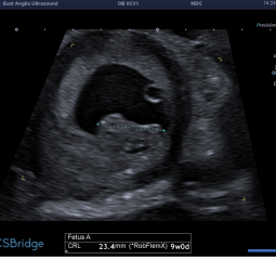 No symptoms/symptom loss in pregnancy