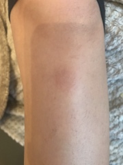 Is this ringworm?