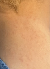 Heat rash or something else?