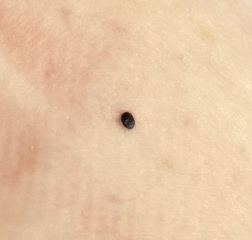 New black mark on skin