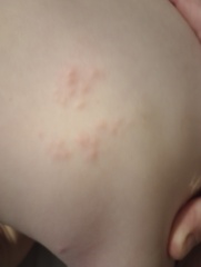 What type of rash/lesion is this?