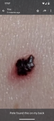 Could this be melanoma?