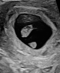 Ultrasound 7 weeks 1d