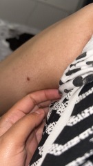 Jus seen this mole on my leg (image attached)