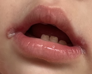 Is it possible that DC caught herpes from nursery?