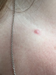 Tick bite - still have a mark 2 months later