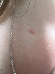 Tick bite - still have a mark 2 months later