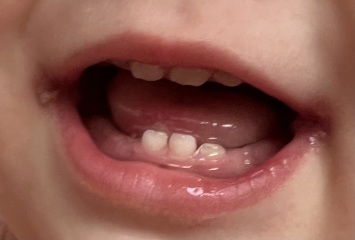 Is it possible that DC caught herpes from nursery?