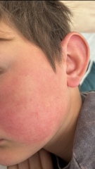 Is this slapped cheek in a 10 year old?