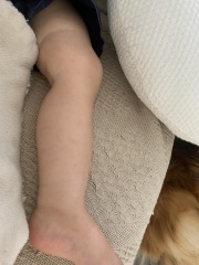 Rash on toddler’s legs