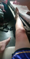 Will this burn leave a scar? Should I use a cream or oil? (Ugly) pic attached