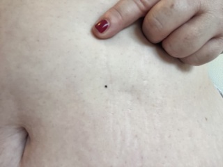 New black spot on skin