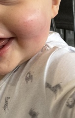 1yo fell on plastic lid