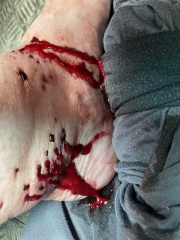 Attacked by Leeches- TMI Photos