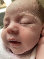 Little spots on babies face