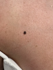 This is a dodgy mole isn't it