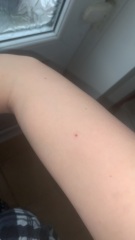 Mole changes
