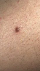 Jus seen this mole on my leg (image attached)