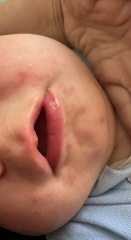 Chickenpox??