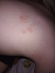 What type of rash/lesion is this?