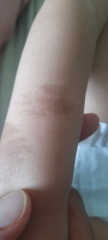 Cafe au lait birthmarks/NF1- who does the diagnosis
