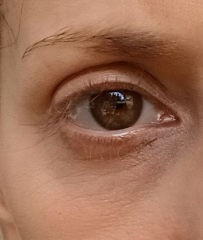 Fine lines and crows feet around eyes