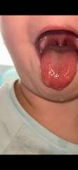 Are these white bumps on my child’s tongue ulcers?