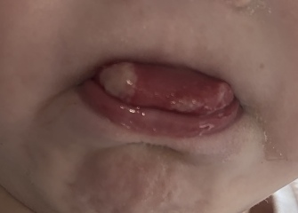 Are these white bumps on my child’s tongue ulcers?