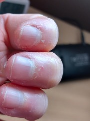 Peeling skin on fingertips - any ideas? Definitely NOT because I don't moisturise ;-)