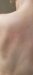 What is this on my toddler? Itchy?!
