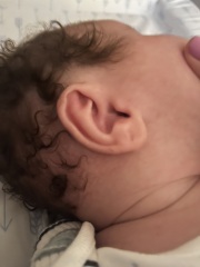 Baby has one ear bigger than other