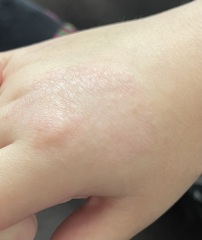 What does this look like on my daughter’s hands? Photos attached.