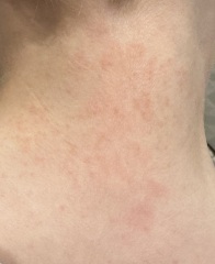Heat rash or something else?