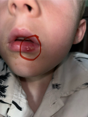 To have no idea what to do about cold sore?