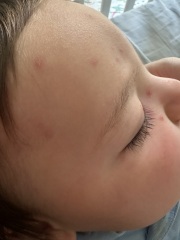Chickenpox??
